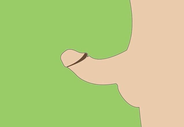 curvature of the penis as an indication for surgical enlargement